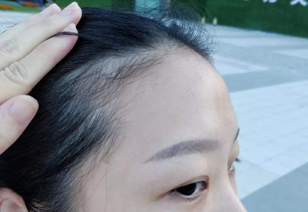 什么是拔毛癖？為什么一焦慮就拔頭發(fā)？